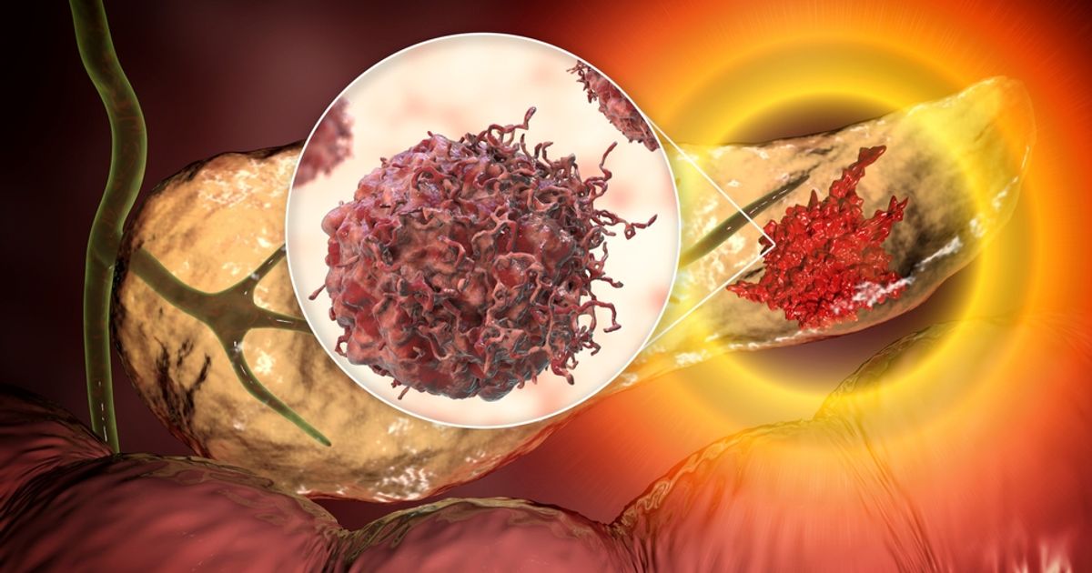 Novi lijek za rak gušterače prošao treću fazu ispitivanja | Telegram.hr