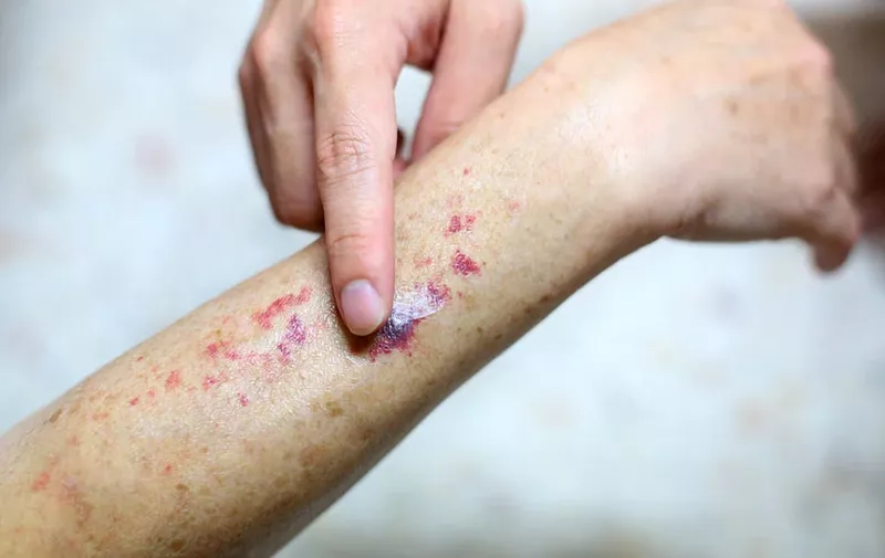 Leukemija: Rani znakovi i simptomi - crvene tokice i modrice | Telegram.hr