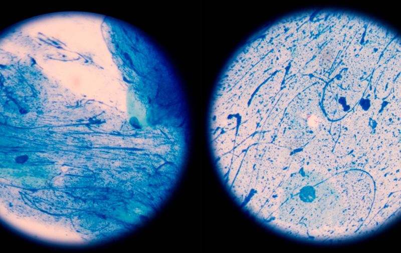 Mycobacterium tuberculosis is a pathogenic bacterial species in the family Mycobacteriaceae and the causative agent of most cases of tuberculosis.in left Negative ,in right scanty 2 cells per 100 oil field.