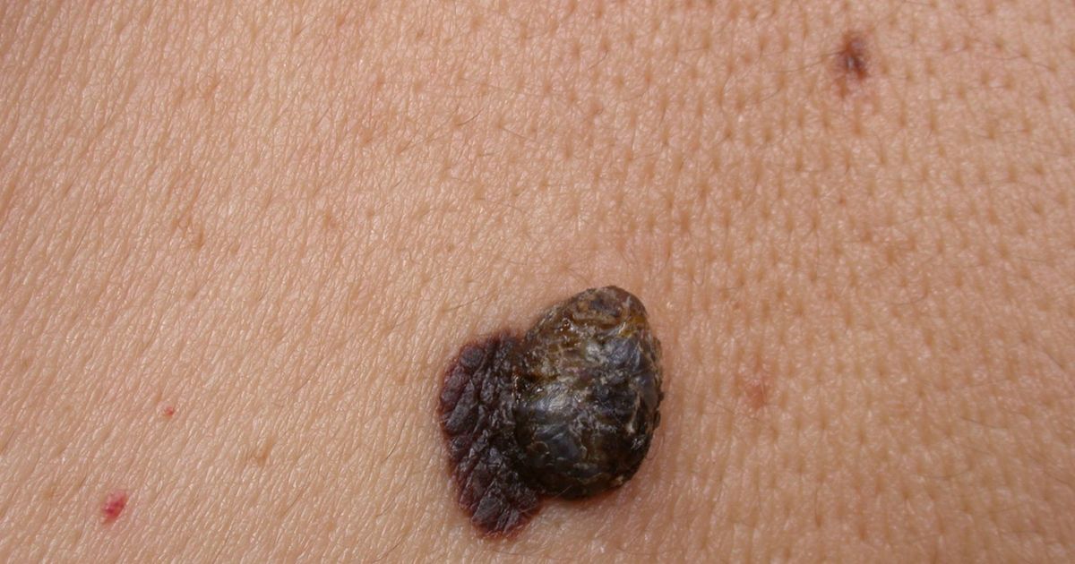 Melanom više nije najsmrtonosniji rak kože: Liječnici upozoravaju na ...