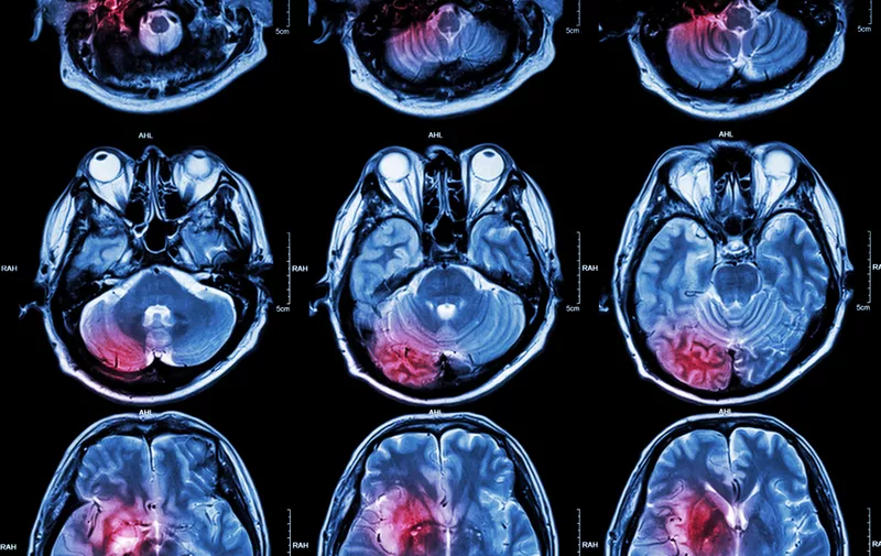 Film MRI ( Magnetic resonance imaging ) of brain ( stroke , brain tumor , cerebral infarction , intracerebral hemorrhage )  ( Medical , Health care , Science Background ) ( Cross section of brain )