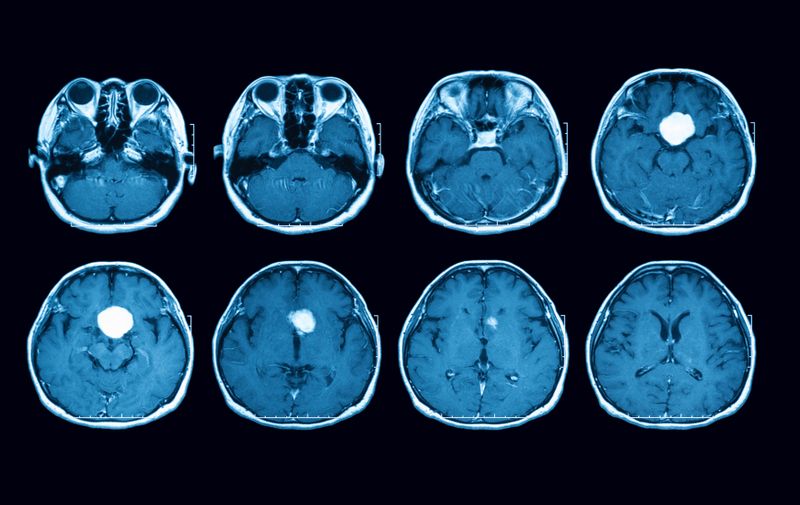 Magnetic resonance imaging (MRI) scan of the brain with gadolinium (GD) contrast medium injections , transverse view, case of pituitary mass