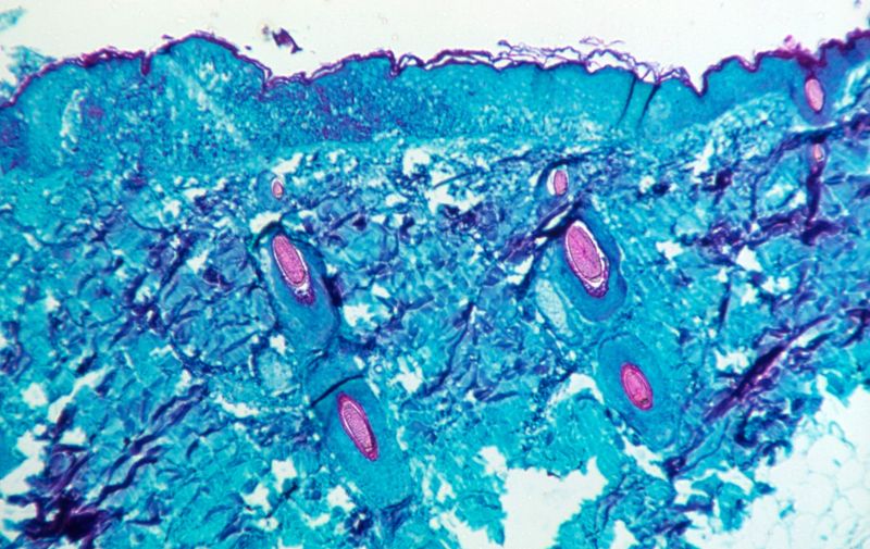 Light micrograph of a skin tissue sample infected with monkeypox virus taken from a lesion on a monkey. Monkeypox particles are composed of a DNA (deoxyribonucleic acid) genome surrounded by a protein coat and lipid envelope. This virus, which is found near rainforests in Central and West Africa causes disease in humans and monkeys, although its natural hosts are rodents. It is capable of human to human transmission. In humans it causes fever, swollen glands and a rash of fluid-filled blisters. It is fatal in 10 per cent of cases. Image obtained in 1968.,Image: 625226900, License: Rights-managed, Restrictions: Model Released, Model Release: yes, Credit line: Profimedia