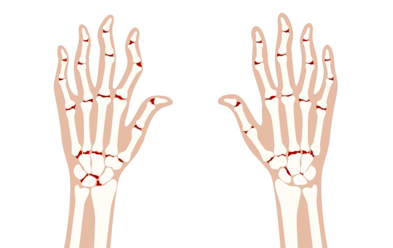 Pain and inflammation in hand on x ray. Rheumatoid arthritis symptom on human joints and bones. Skeleton scan concept. Finger disease flat vector illustration. Banner, poster for clinic and hospital