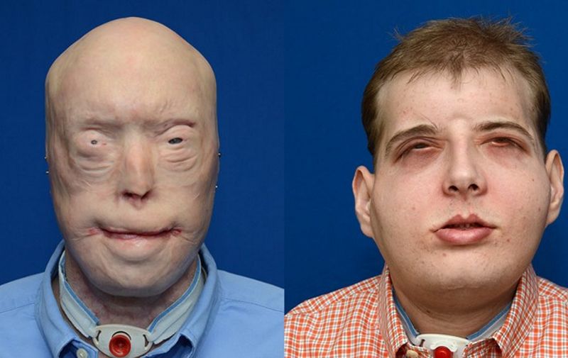 This combination photo provided November 16, 2015 by the NYU Langone Medical Center shows face transplant patient Patrick Hardison before(L) and after his surgery. A New York medical center said November 16, 2015 it had performed the most complex and comprehensive face transplant to date, performed on a 41-year-old first responder horribly disfigured in 2001. More than 100 doctors, nurses, technical and support staff took part in the 26-hour operation, conducted in mid-August at the NYU Langone Medical Center, the center announced. The recipient was Patrick Hardison, from Senatobia, Mississippi who suffered extensive facial burns as a volunteer firefighter, just days before the September 11, 2001 attacks. Hardison was severely disfigured when the roof of a burning home collapsed on top of him during a rescue search, losing his eyelids, ears, lips, most of his nose, hair and eyebrows. Eduardo Rodriquez, chair of the Hansjorg Wyss Department of Plastic Surgery, led the surgery following a year of preparation, the medical center announced. AFP PHOTO / HANDOUT / NYU LANGONE MEDICAL CENTER   == NO SALES==    == RESTRICTED TO EDITORIAL USE / MANDATORY CREDIT: "AFP PHOTO / HANDOUT /  NYU LANGONE MEDICAL CENTER "/ NO MARKETING / NO ADVERTISING CAMPAIGNS / DISTRIBUTED AS A SERVICE TO CLIENTS ==