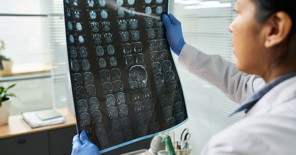 Novi model umjetne inteligencije mogao bi pomoći u otkrivanju genetskog rizika od moždanog udara