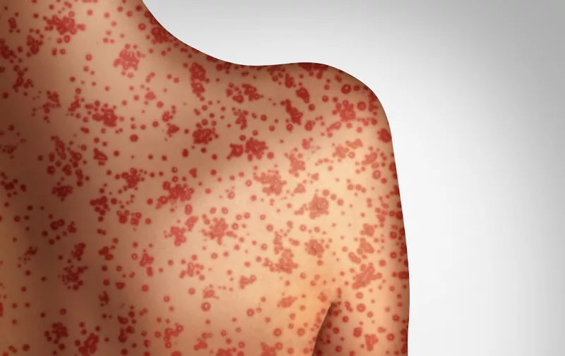 Measles concept as a deadly outbreak immunize,disease and viral illness as a contagious chickenpox or a skin rash in a 3D illustration style., Image: 423028023, License: Royalty-free, Restrictions: , Model Release: yes, Credit line: Profimedia, Depositphotos Inc.