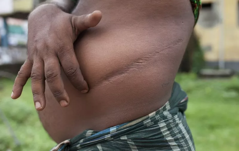 To go with Bangladesh-Crime-Trafficking-Organs FEATURE by Shafiqul Alam
In this photograph taken on August 1, 2015, Bangladeshi villager Mokaram Hossian, 35, a victim of illegal organ trade, shows the scars from his illegal kidney removal operation in the village of Kalai some 300 kms (185 miles) northwest of Dhaka.  Some eight million Bangladeshis suffer from kidney disease, mostly because of high rates of diabetes, and at least 2,000 need transplants annually. But donation is only legal between living relatives, resulting in a chronic shortage of kidneys for transplant. A lucrative blackmarket has filled the void, with a steady stream of desperate buyers and equally desperate and poor donors.   AFP PHOTO/SUVRA KANTI DAS / AFP / SUVRA KANTI DAS