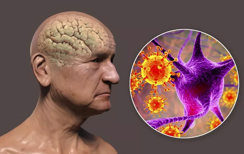 Infectious aetiology of dementia. Conceptual computer illustration showing an elderly person with progressive impairments of brain functions and viruses attacking neurons. (Photo by KATERYNA KON/SCIENCE PHOTO LIBRA / KKO / Science Photo Library via AFP)