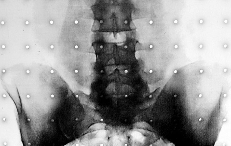 Bolovi u donjem dijelu leđa – bolest modernog čovjeka