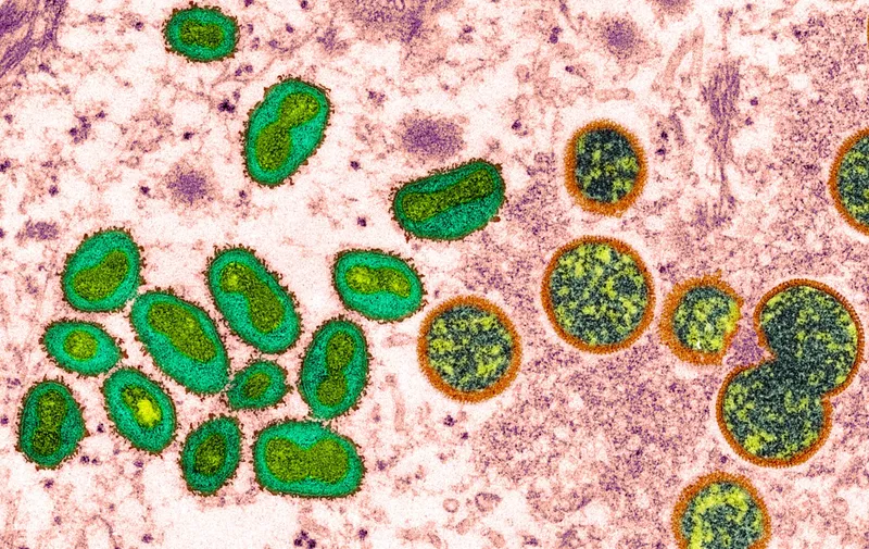 Coloured transmission electron micrograph (TEM) showing monkeypox virus particles from a human skin sample. On the left, mature, oval shaped virus particles are seen. Immature virus particles (circular shaped, right) are also seen. Monkeypox particles are composed of a DNA (deoxyribonucleic acid) genome surrounded by a protein coat and lipid envelope. This virus, which is found near rainforests in Central and West Africa, causes disease in humans and monkeys, although its natural hosts are rodents. It is capable of human to human transmission. In humans it causes fever, swollen glands and a rash of fluid-filled blisters. It is fatal in 10 per cent of cases.,Image: 697909169, License: Rights-managed, Restrictions: , Model Release: no, Credit line: Profimedia