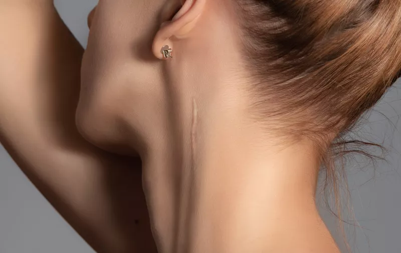 Woman with surgery scar at her neck.