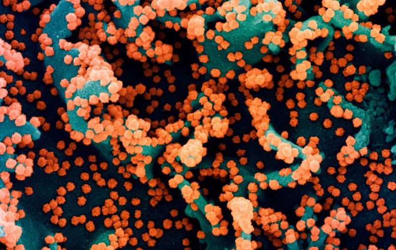 Coloured scanning electron micrograph (SEM) showing a cell (blue) being heavily infected by SARS-CoV-2 virus particles (orange). SARS-CoV-2 causes the respiratory infection Covid-19, which can lead to fatal pneumonia.
