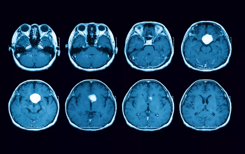 Magnetic resonance imaging (MRI) scan of the brain with gadolinium (GD) contrast medium injections , transverse view, case of pituitary mass