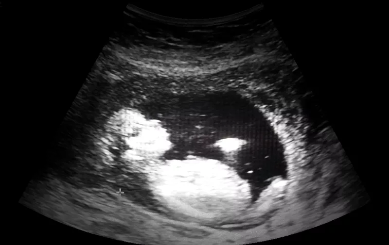 ultrasound film of thirteen week fetus