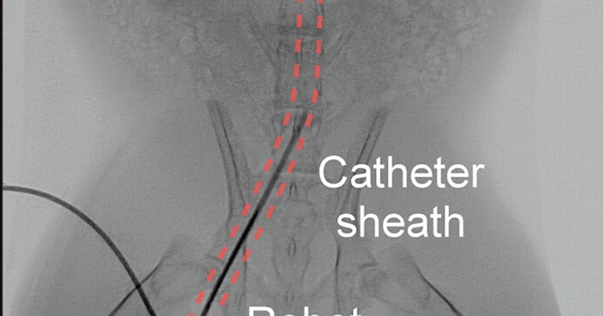 Chinese scientists develop tiny robot to break down blood clots and detect cancer cells